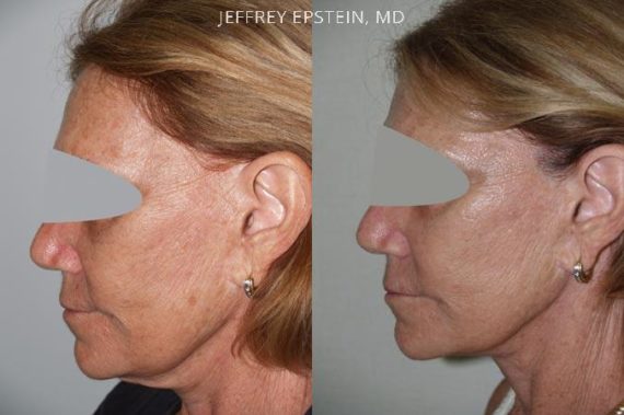 Combo Procedures Before and after in Miami, FL, Paciente 35207