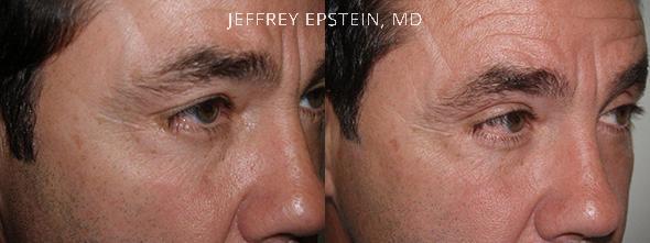 Combo Procedures Before and after in Miami, FL, Paciente 35213