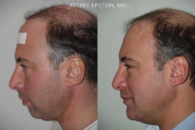 Combo Procedures Before and after in Miami, FL, Paciente 35220