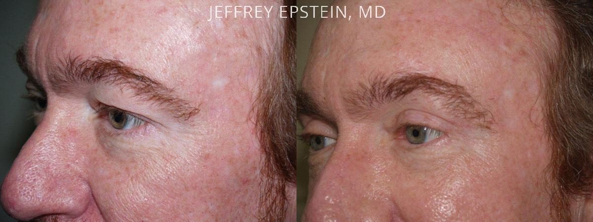 Combo Procedures Before and after in Miami, FL, Paciente 35229