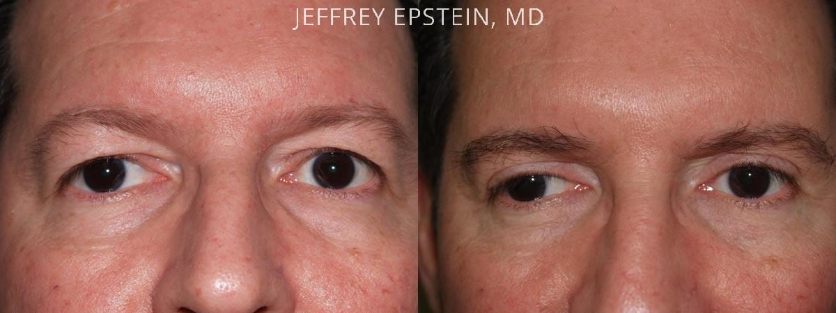 Combo Procedures Before and after in Miami, FL, Paciente 35234