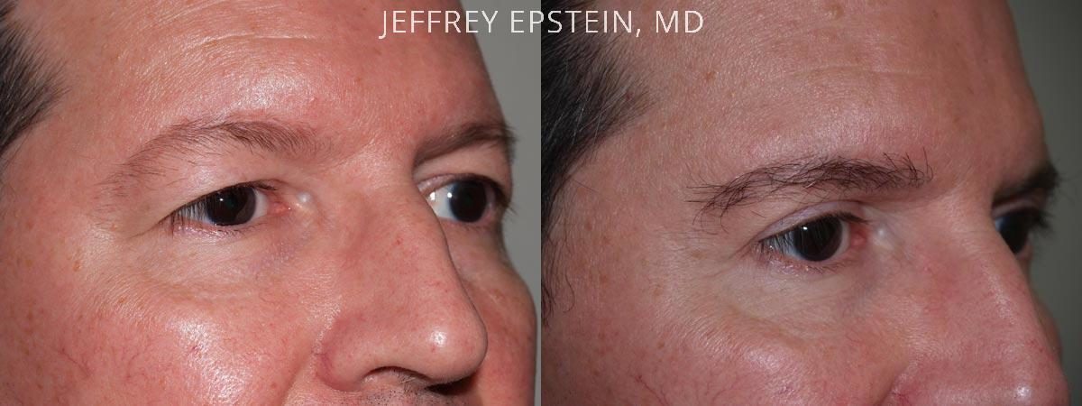 Combo Procedures Before and after in Miami, FL, Paciente 35234