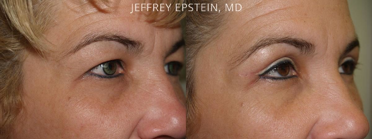 Combo Procedures Before and after in Miami, FL, Paciente 35253