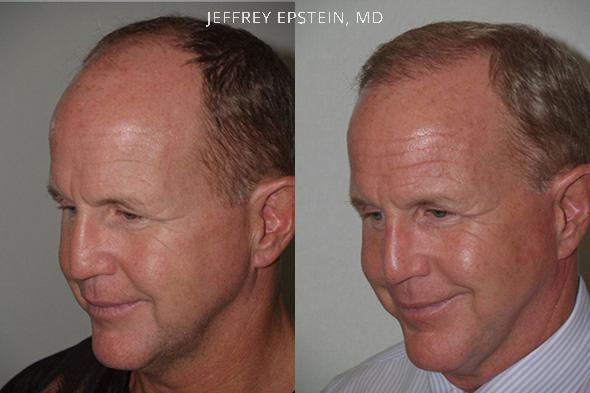 Combo Procedures Before and after in Miami, FL, Paciente 35258