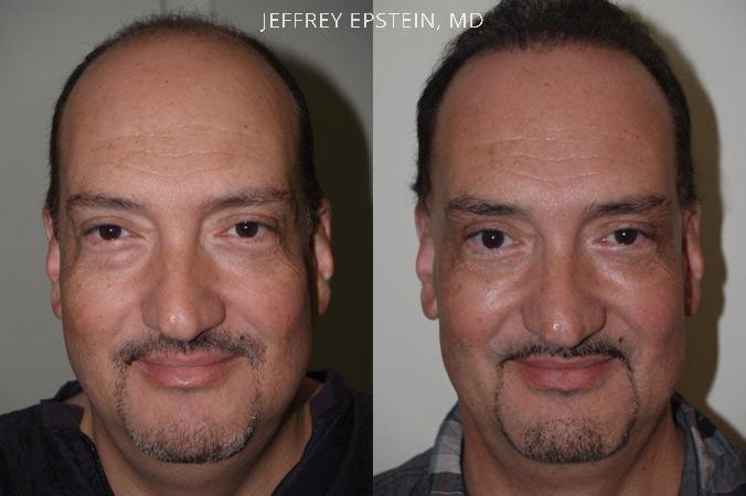 Combo Procedures Before and after in Miami, FL, Paciente 35270