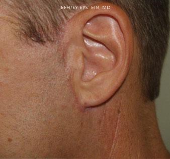 Combo Procedures Before and after in Miami, FL, Paciente 35279