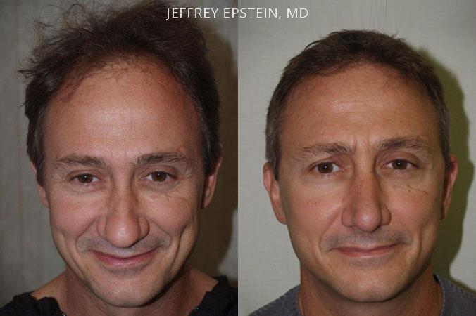 Combo Procedures Before and after in Miami, FL, Paciente 35279