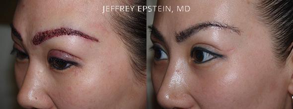 Combo Procedures Before and after in Miami, FL, Paciente 35294