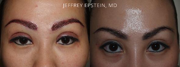 Combo Procedures Before and after in Miami, FL, Paciente 35294