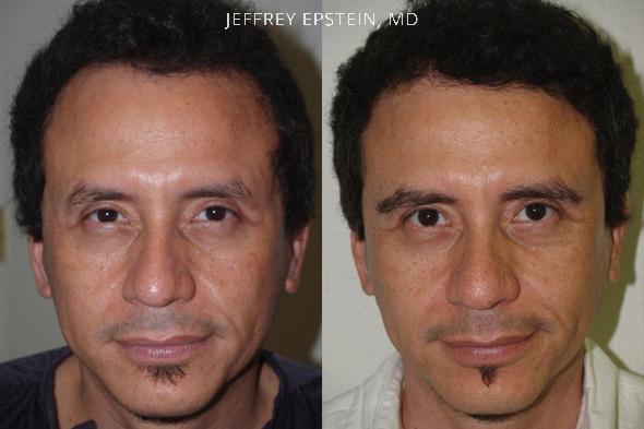 Eyebrow Hair Transplant Before and after in Miami, FL, Paciente 35673