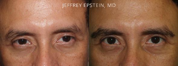 Eyebrow Hair Transplant Before and after in Miami, FL, Paciente 35673