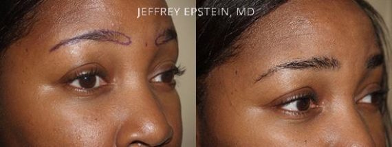 Eyebrow Hair Transplant Before and after in Miami, FL, Paciente 35702