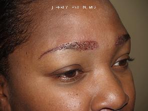 Eyebrow Before and after in Miami, FL, Paciente 35702