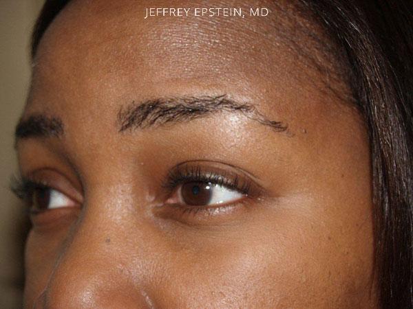 Eyebrow Hair Transplant Before and after in Miami, FL, Paciente 35702