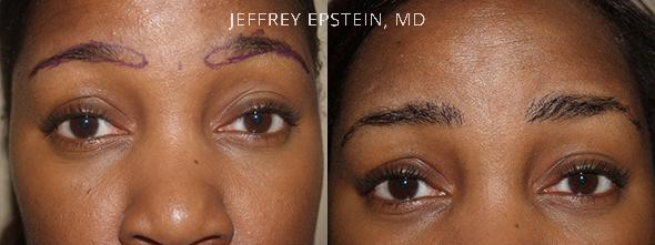Eyebrow Before and after in Miami, FL, Paciente 35702