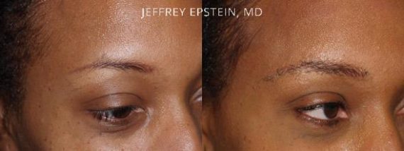 Eyebrow Hair Transplant Before and after in Miami, FL, Paciente 35735