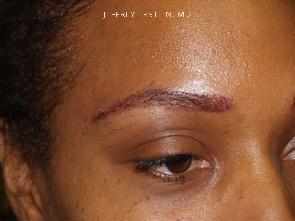 Eyebrow Hair Transplant Before and after in Miami, FL, Paciente 35735