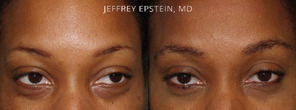 Eyebrow Before and after in Miami, FL, Paciente 35735