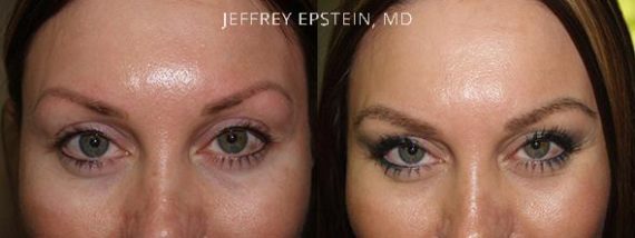 Eyebrow Hair Transplant Before and after in Miami, FL, Paciente 35765
