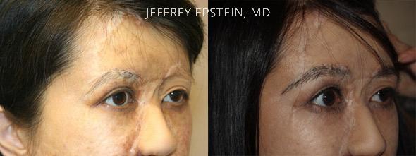 Eyebrow Before and after in Miami, FL, Paciente 35770