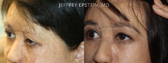Eyebrow Before and after in Miami, FL, Paciente 35770