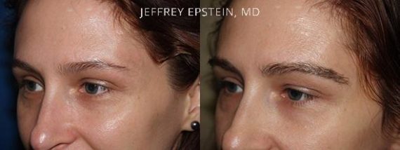Eyebrow Hair Transplant Before and after in Miami, FL, Paciente 35782