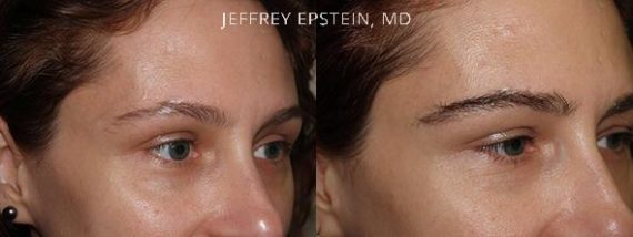 Eyebrow Hair Transplant Before and after in Miami, FL, Paciente 35782