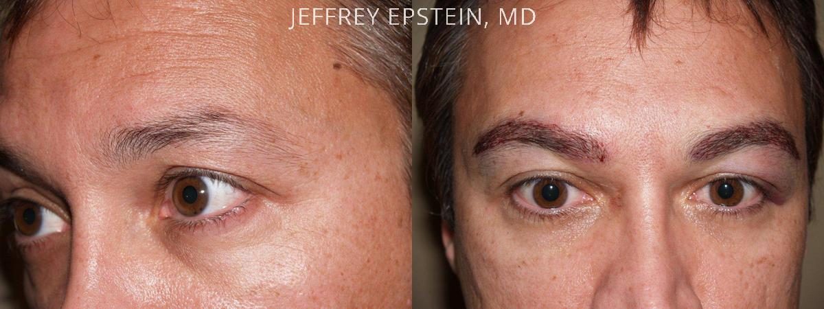 Eyebrow Hair Transplant Before and after in Miami, FL, Paciente 35796