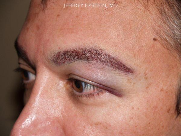Eyebrow Hair Transplant Before and after in Miami, FL, Paciente 35796