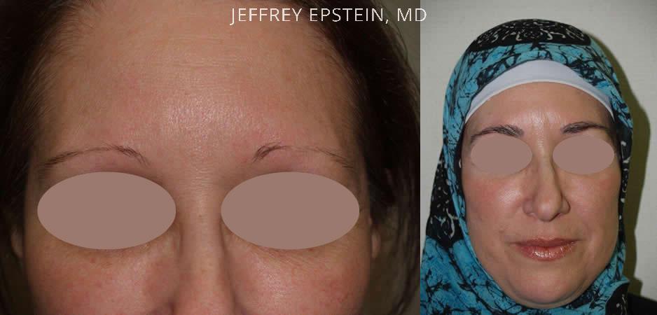 Eyebrow Hair Transplant Before and after in Miami, FL, Paciente 35806