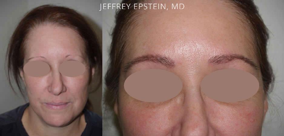 Eyebrow Hair Transplant Before and after in Miami, FL, Paciente 35806