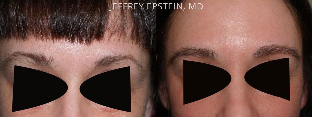 Eyebrow Hair Transplant Before and after in Miami, FL, Paciente 35812