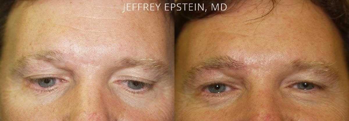 Eyebrow Hair Transplant Before and after in Miami, FL, Paciente 35830