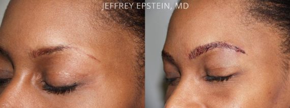 Eyebrow Hair Transplant Before and after in Miami, FL, Paciente 35849