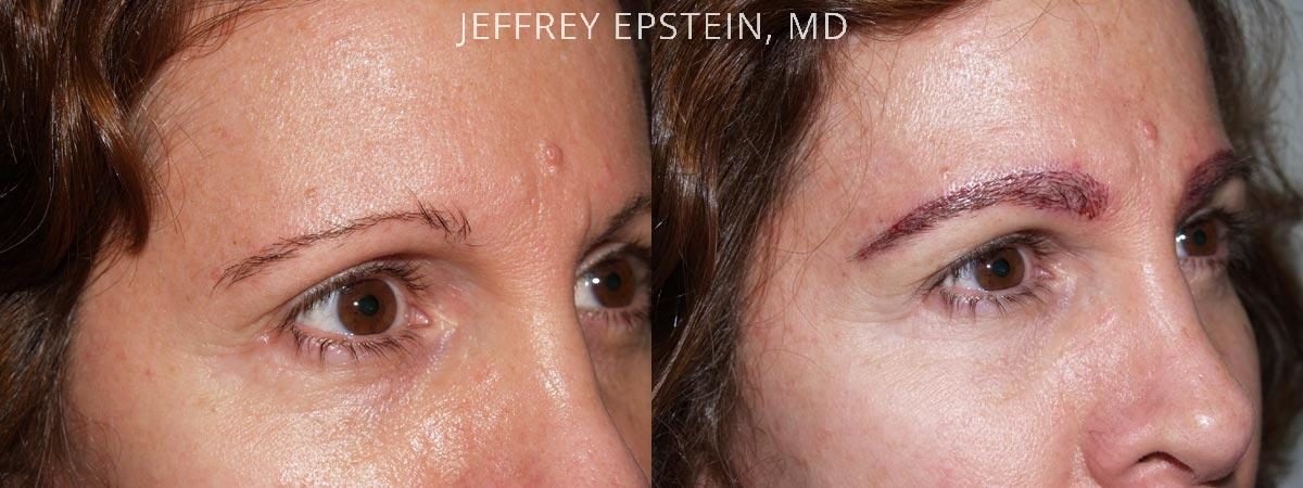 Eyebrow Before and after in Miami, FL, Paciente 35852