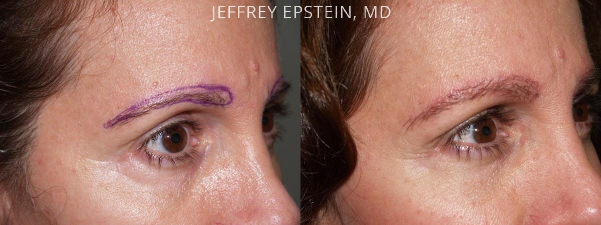 Eyebrow Hair Transplant Before and after in Miami, FL, Paciente 35852