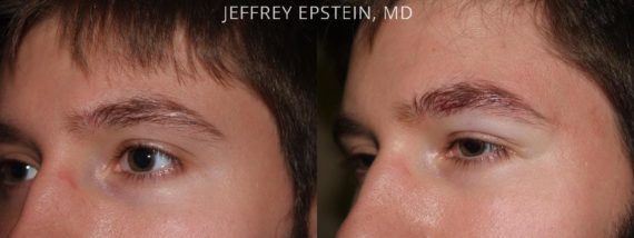 Eyebrow Hair Transplant Before and after in Miami, FL, Paciente 35876