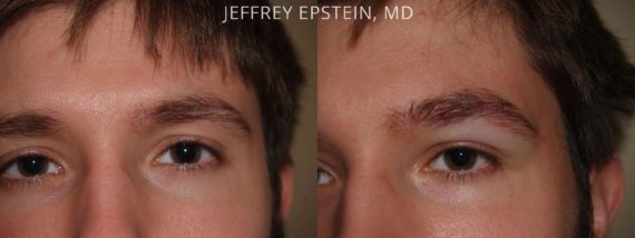 Eyebrow Hair Transplant Before and after in Miami, FL, Paciente 35876
