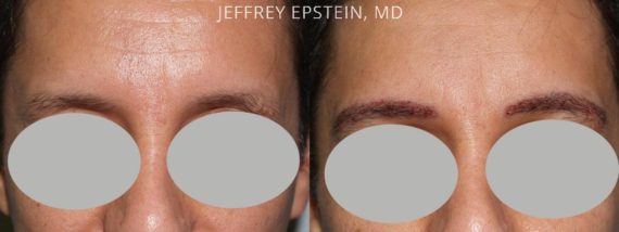 Eyebrow Hair Transplant Before and after in Miami, FL, Paciente 35900