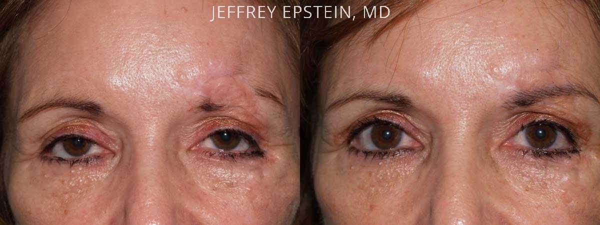 Eyebrow Hair Transplant Before and after in Miami, FL, Paciente 35903