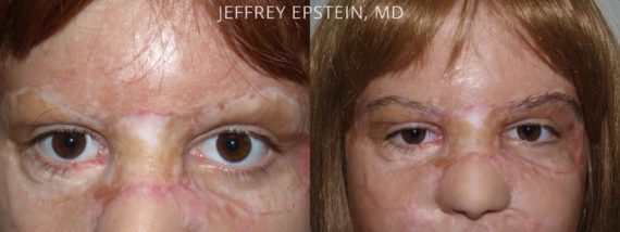 Eyebrow Hair Transplant Before and after in Miami, FL, Paciente 35928