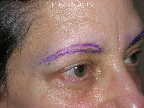 Eyebrow Hair Transplant Before and after in Miami, FL, Paciente 35935
