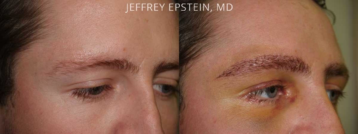 Eyebrow Hair Transplant Before and after in Miami, FL, Paciente 35939