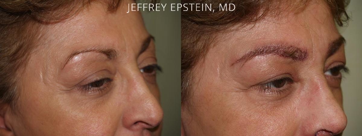 Eyebrow Hair Transplant Before and after in Miami, FL, Paciente 35954