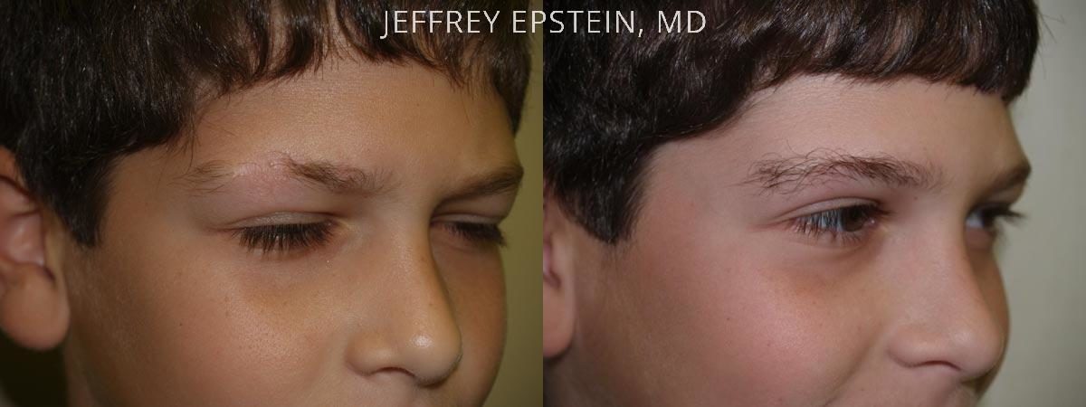 Eyebrow Hair Transplant Before and after in Miami, FL, Paciente 35966