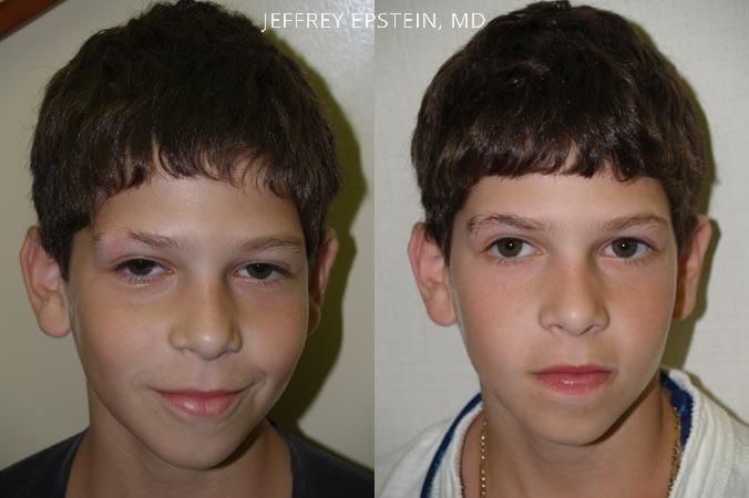 Eyebrow Hair Transplant Before and after in Miami, FL, Paciente 35966