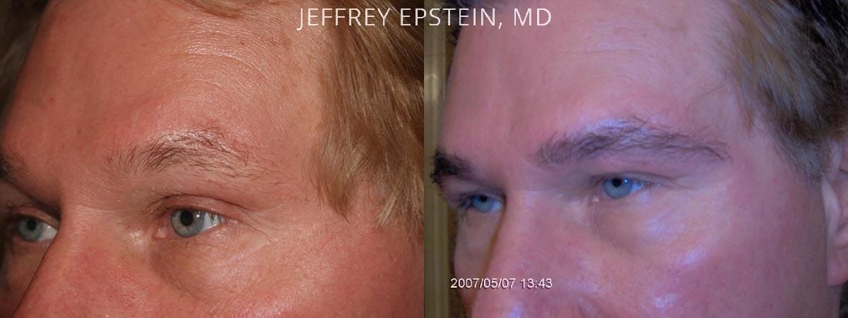 Eyebrow Hair Transplant Before and after in Miami, FL, Paciente 35974