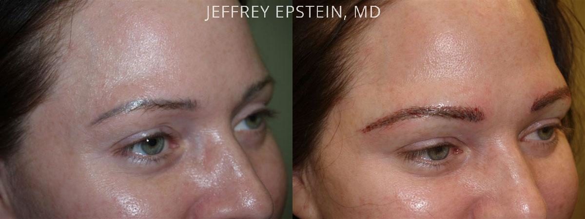 Eyebrow Hair Transplant Before and after in Miami, FL, Paciente 35979