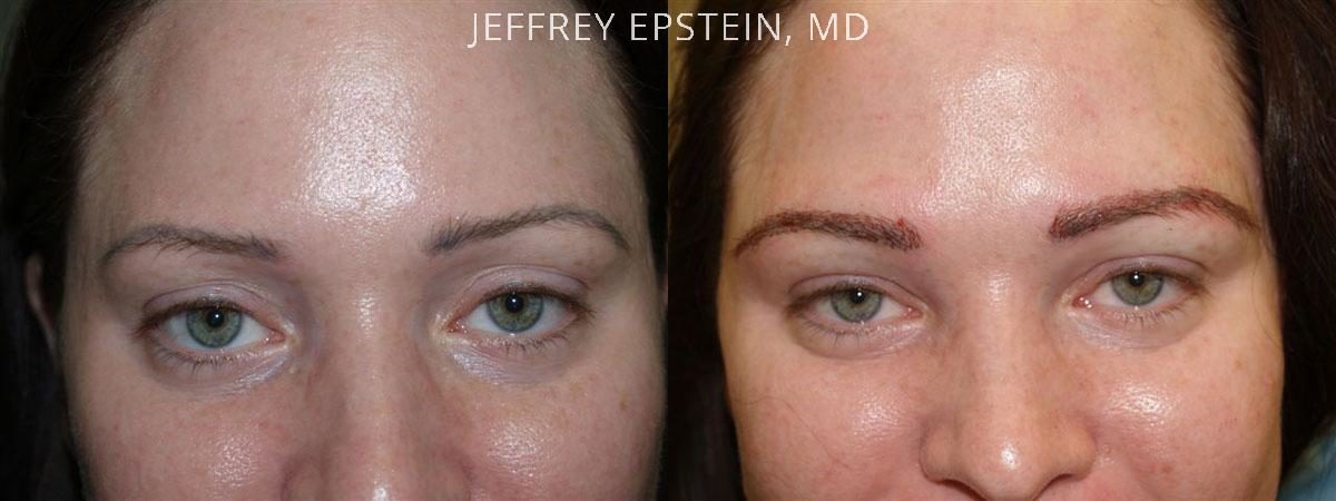 Eyebrow Before and after in Miami, FL, Paciente 35979