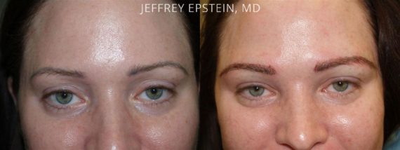 Eyebrow Hair Transplant Before and after in Miami, FL, Paciente 35979